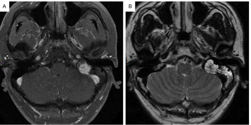 Figure 1. Radiologic characterization of endolymphatic sac tumor (ELST). A: Magnetic resonance images scan re-vealed a 19 mm×18 mm mass in the left petrous segment of temporal bone which was irregular, heterogeneous signal intensity on T1-weighted axial im