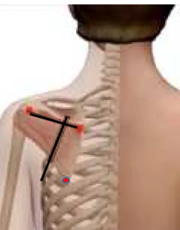 Figure 2. Landmarks for Identification of the Infraspinatus 