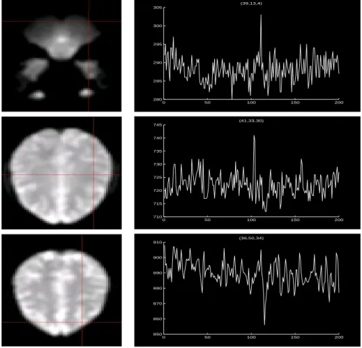 Figure 3.1: Examples of spikes in our fMRI data set. The left column contains the images for three slices of the brain