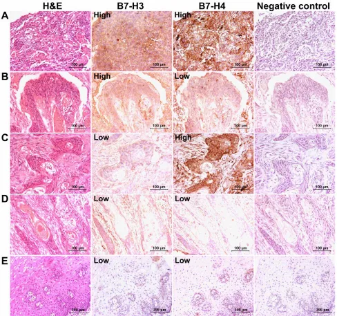 Figure 1: B7-H3 and B7-H4 immunostaining in human esophageal cancer tissues. The panel A