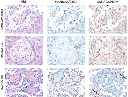 Figure 2. Immunohistochemical analysis of SMARCA4/BRG1 and SMARCA2/BRM in ovarian clear cell carcinoma