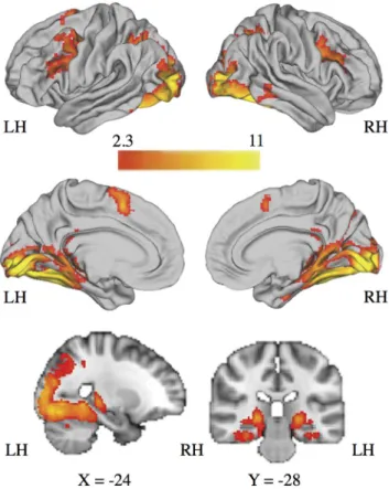 Figure 6. Bilateral posterior hippocampal BOLD signal during context encoding (angry facial cue ⬎ ITI) and context memory accuracy on trials involving angry facial targets.