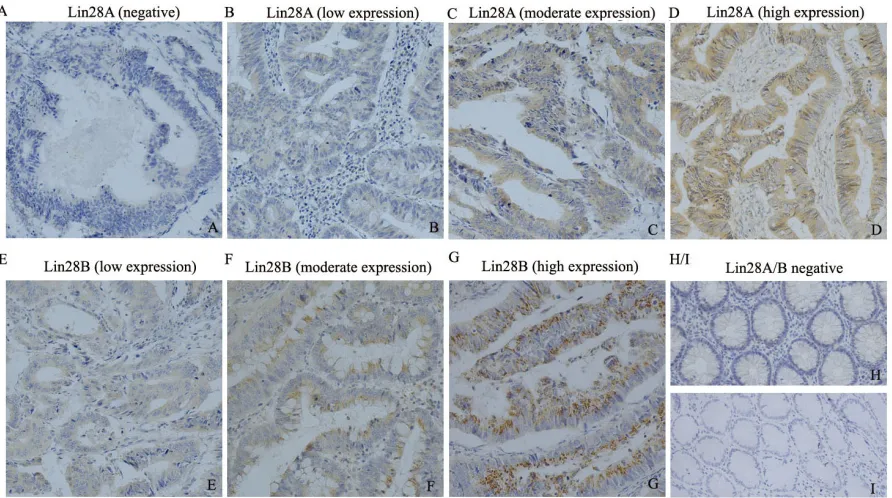 Figure 1: The expression pattern of Lin28A and Lin28B in colon cancer tissues detected by immunohistochemistry (200×)
