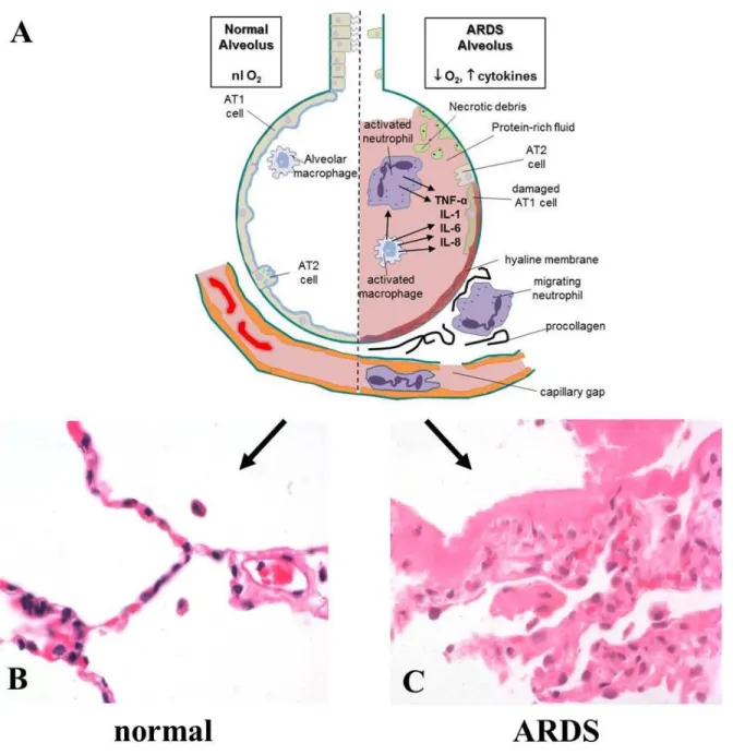 Figure 1.2. Alveolar pathology in ARDS. (A) Representation of normal alveoli and  pathologic alveoli due to ARDS, indicating the fluid-flooded and pro-inflammatory state  characteristic of ARDS, as well as epithelial cell death and hyaline membrane formati