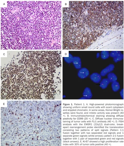 Figure 1. Patient 1. A. High-powered photomicrograph taining of tumor cells with FLi1 antibody analysis with the EWSR1 (22q12) dual-color, break-apart rearrangement probe identified the translocation consisting two patterns of split signals (Pattern 1:1 fu
