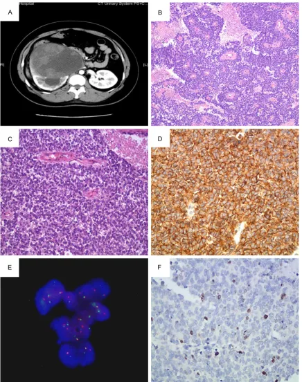 Figure 2. Patient 2. A. Preoperative computed tomography scans of the abdomen in transverse views revealing a toplasm, uniform nuclei, and stippled chromatin (20 ×)