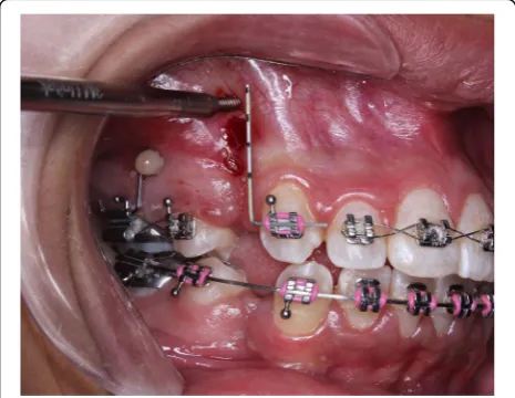 Fig. 1 Intra-oral photograph showing the procedure of MOPs usinga TAD (note the permanent marks on the vertical segment of thewire guide dividing two thirds of the canine root length into equalthirds, such that one MOP was performed for each third)