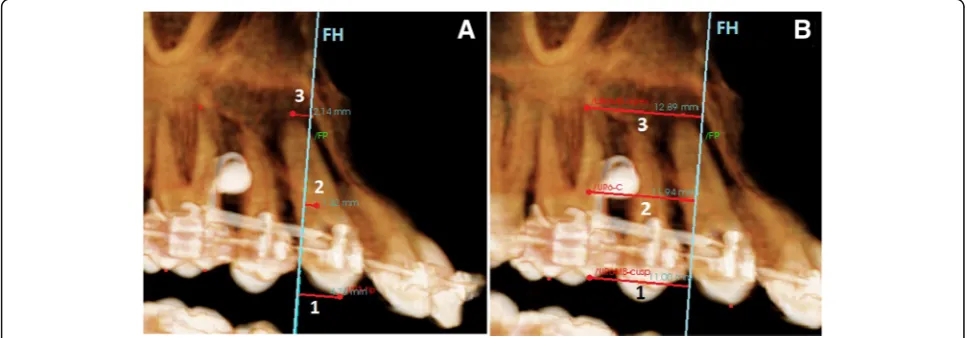 Fig. 2 Landmarks used in digital model assessment. a Upper right canine cusp tip. b MB cusp tip of upper right first molar