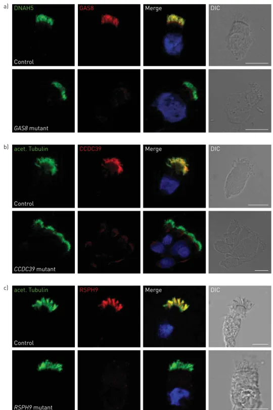 FIGURE 3 Immunofluorescence microscopy can be used to identify structural defects of motile cilia and to aid diagnosis of primary ciliary dyskinesia