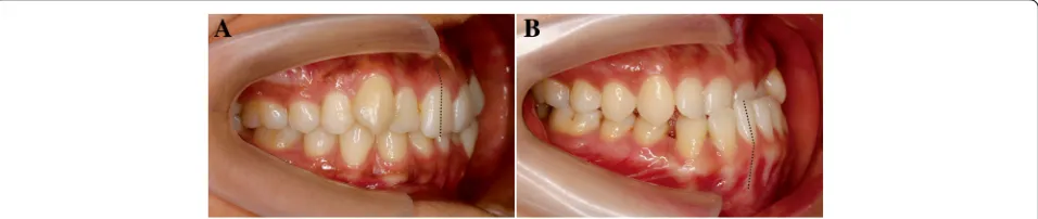 Fig. 1 a, b The inclination of the root and crown in maxillary and mandibular incisors are inconsistent with each other in the surface view, whichindicates the crown-root angulation phenomenon