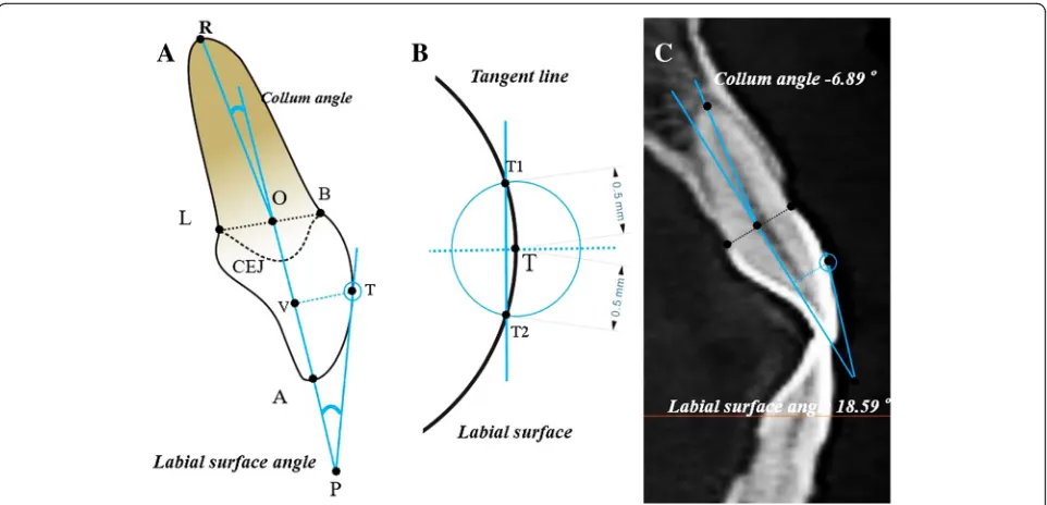 Fig. 4 aupper and lower intersections of labial surface of crown and circle with the T center and radius of 0.5 mm