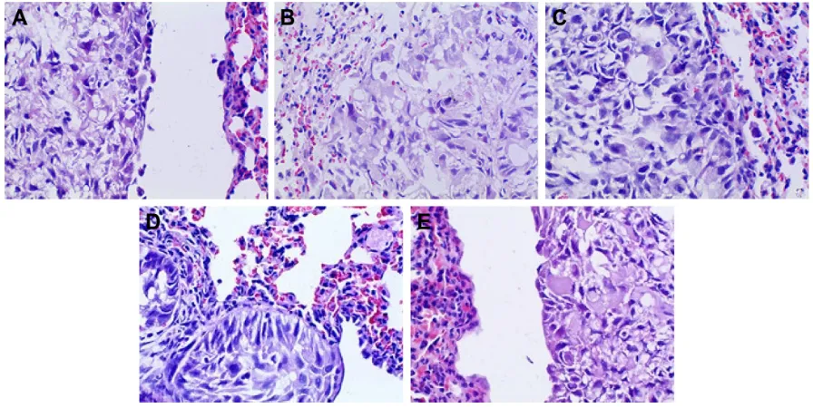 Figure 10 Pathomorphological changes of a549 tumor section in all the groups (×100).Notes: (A) Positive group, (B) combination group, (C) test group, (D) reference group, and (E) model group.