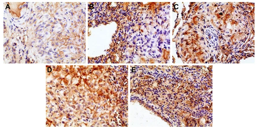 Figure 12 Immunohistochemical staining for VegF of orthotopic tumors in all the groups.Notes: (A) Positive group, (B) combination group, (C) test group, (D) reference group, and (E) model group