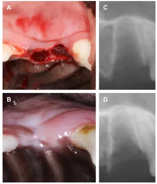 Figure 7 Implantation of gO scaffold to extraction socket.Notes: (A) Photograph of implanted scaffold