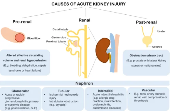 Figure 2. Clinical paradigm of AKI with pre-renal, renal or post-renal causes. AKI with a pre-renal cause, due to altered effective  circulating volume, such as bleeding, dehydration and/or heart failure leading to reduced renal perfusion, is most prevalen