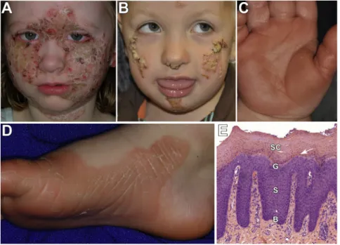 Figure 2. Clinical and Histologic PSEK Features Due to KDSR Mutations