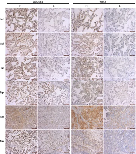 Figure 1: Immunohistochemical analyses of CDC25a and YBX1 proteins in different subtypes of lung adenocarcinoma.The expression of CDC25a and YBX1 in MIA was detected by IHC assay