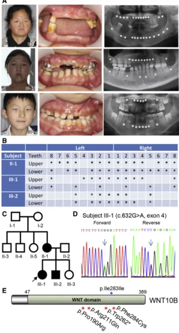 Figure 1. Autosomal-Dominant Oligodontia and Identification of the WNT10B Mutation