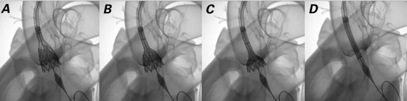 Fig. 4  Images show the recapturability feature of the CoreValve Evolut R valve: A) valve too deep; B) recapture begins; C) partially  recaptured; D) valve fully recaptured