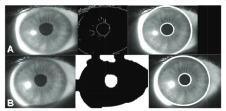 Figure 3 Application of segmentation techniques. Segmentation following: (a) Masek's technique showing image prior to segmenta-tion; binary edge map obtained by the Canny operator; and resultant segmented image; (b) Daugman's technique with the proposed en-hancement incorporated showing image prior to segmentation; thresholded image; and resultant segmented image.