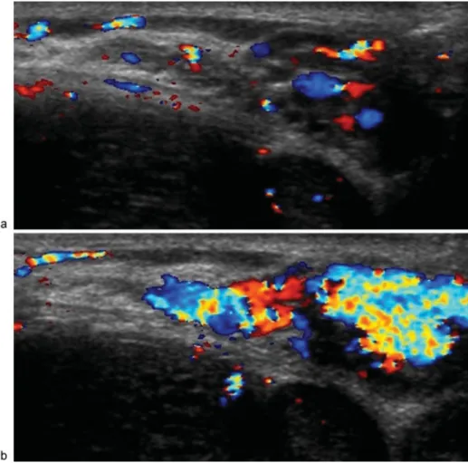 Table 3 Ultrasound grading of varicoceles