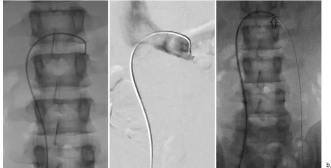 Fig. 4 A 17-year-old male requiring left varicocele embolization. (a) A 5F catheter was positioned in the distal left internal spermatic vein and venogram was performed