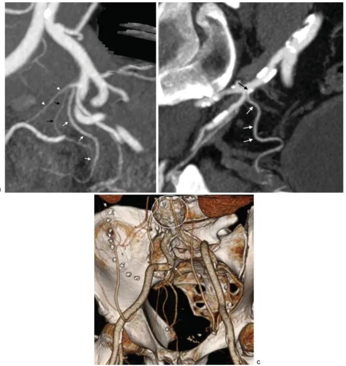 Fig. 2 (a) Left anterior oblique maximum intensity projection computed tomography angiography (MIP CTA) image demonstrating an anatomic conﬁguration in which prostatic artery catheterization can potentially be difﬁcult