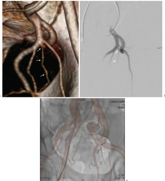 Fig. 4 (a) Right anterior oblique 3D volume-rendered CTA image demonstrating the optimal obliquity for visualizing the origin of the left anterior/lateral prostatic artery (white arrows)