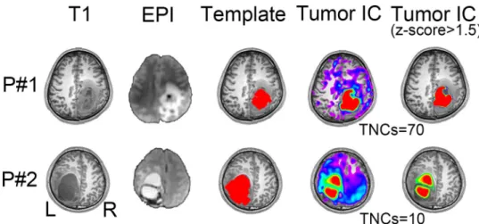 Figure 3.  Comparison among 3D-T1 image (1 st  column), mean EPI image (2 nd  column), initial tumor template  (3 rd  column), and the final tumor-related components with and without threshold (the last two columns) from  two randomly selected patients in 