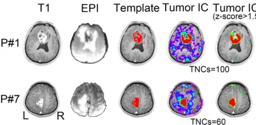 Figure 4.  Comparison among 3D-T1 image (1 st  column), mean EPI image (2 nd  column), initial tumor template  (3 rd  column), and the final tumor-related components with and without threshold (the last two columns) from  two randomly selected patients in 