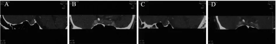 Figure 3: Computed Tomographic (CT) images of pituitary tumors in the case two patient