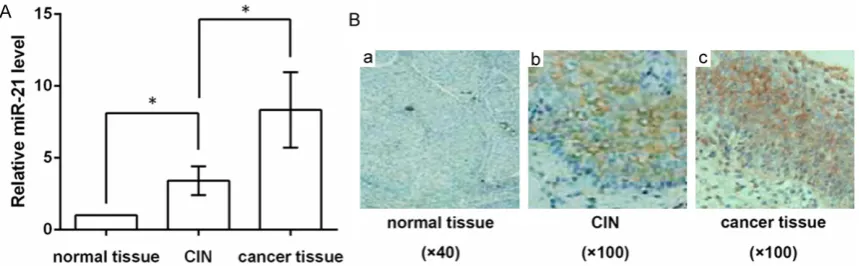 Figure 1. miR-21 level is associated with the pathological progression of cervical cancer