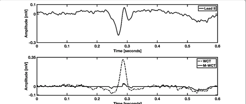 Fig. 3 Example of positive deflection WCT. M-WCT is 11.04% of lead II amplitude, while WCT is 118.82% of lead II amplitude (average); the recording is from a 73-year-old male patient admitted at the hospital
