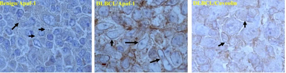Figure 4: Co-localization of Apaf-1 and caveolin (lipid raft marker) in B-cell Lymphoma