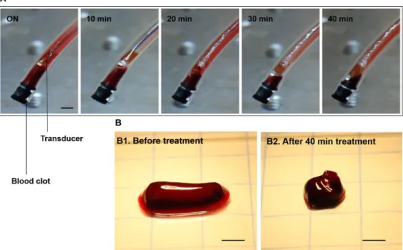Figure 3.  In vitro clot lysis by microbubble-mediated intravascular ultrasound. (A) Captured images during  40 min treatment by using the planar-aperture prototype (input conditions of 620 kHz, 80 V pp , 10% duty cycle  with 100 μl/min injection of 50 8  