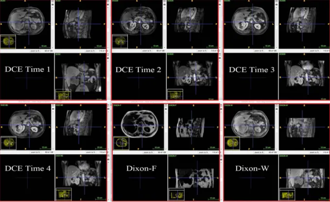 Figure 2.  The multimodal intra-subject registered results of subject 1 except PET. There are 6 red boxes,  which are divided into 2 rows and 3 columns