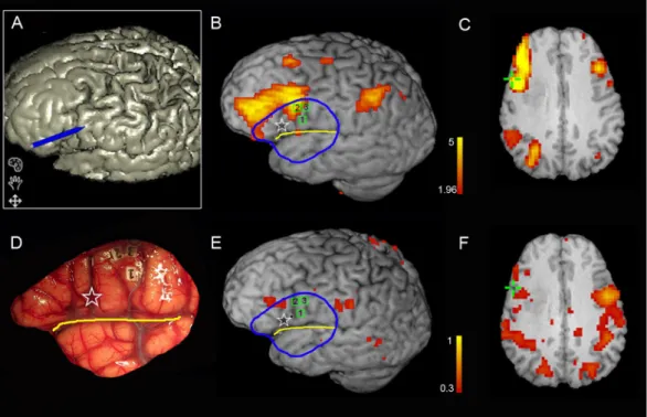 Figure 5.  Comparison of language mapping and ISM results for the representative patient #7