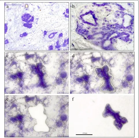 Figure 1 Cresyl Violet stained breast tissue. a) Low magnification overview, scanned with a MiraxViewer slide scanner; b) Illustration of howlipids from normal breast tissue can collect between the membrane and the slide on MembraneSlides and cause technical difficulties; c)Overview of the LCM area; d) Cut line around structure of interest; e) Area after catapulting; f) Catapulted piece collected in the cap.