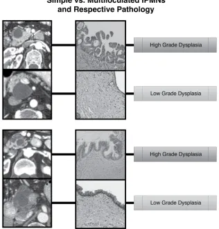 Figure 3: Principle component analysis (PCA) demonstrating a pattern of separation of between high grade and low grade IPMNs