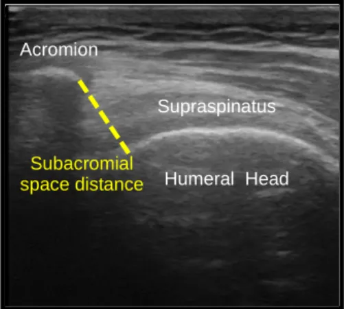 FIGURE 3: Subacromial Space Distance 