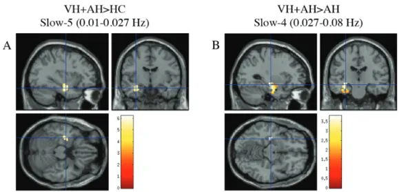 Fig. 3.  Visual hallucinators have significantly increased ALFF in the left hippocampus