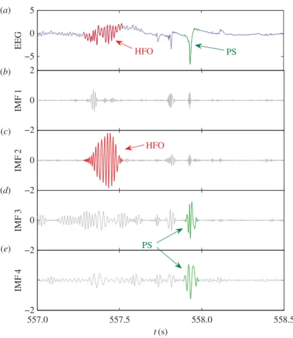 Figure 5. Example of EMD-based HFO detection from EEG data. (a) A 1.5 s segment of normalized EEG data containing an HFO and a population spike