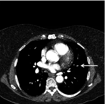 Fig 2. Years algorithm and study flowchart. CTPA, computed tomography pulmonary angiography; PE, pulmonary embolism; ssPE, subsegmental pulmonary embolism.