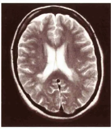 Figure 3.1 Fast spin echo sequence. Proton densit) image showing multiple white matterlesions in a patient with .MS