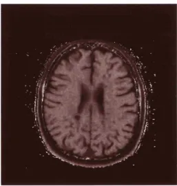 Figure 3.7 Magnetisation transfer sequence. Calculated magnetisation transfer imageshowing multiple white matter lesions in a patient with MS