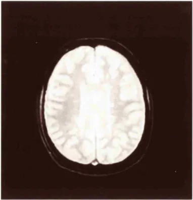 Figure 3.10 Hea\il> Tl weighted ima^e used in the calculation of I 1 relaxation timemaps showing multiple white matter lesions in a patient with .MS
