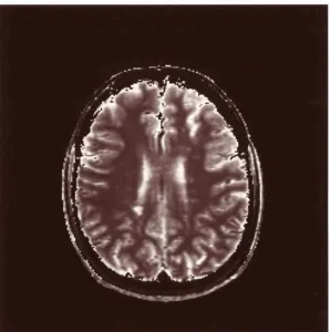 Figure 3.12 Corresponding Tl relaxation time map showing multiple white matterlesions in a patient with .MS