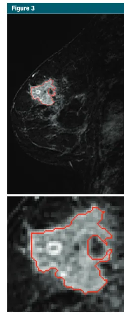 Figure 2:  Sagittal MR images in a case with a  potentially good prognosis, a 75-year-old woman  evaluated as having an ER-positive, PR-positive,  HER2-negative, lymph node–negative, stage II  in-vasive breast cancer