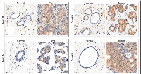 Fig. 2 Immunohistochemistry of SHC1 proteins shows the increased staining of SHC1 proteins in breast cancer cells compared to adjacentnormal breast epithelia or stromal cells in human breast cancer