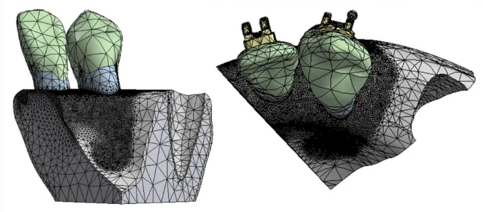 Figure 12: Fine mesh for the limited model, generated with a 0.2mm contact sizing between  the dentin and cortical bone